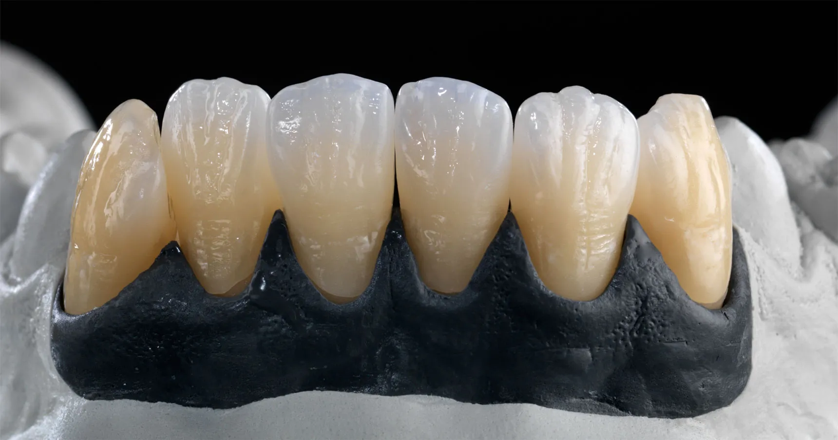 Layered zirconia anterior crowns on a working model