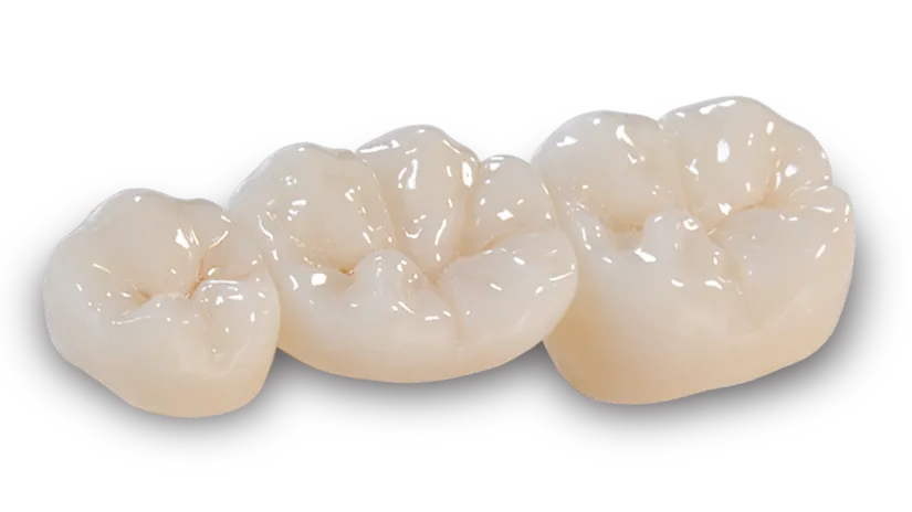 Full-contour zirconia bridge